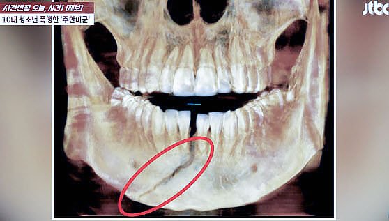 11월 17일 평택역 인근에서 10대 남학생이 30대 주한미군에게 폭행을 당해 턱뼈가 골절되는 중상을 입었다. 사진은 남학생의 엑스레이 사진. JTBC '사건반장' 갈무리